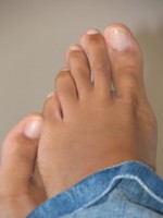 Síntomas-Micosis-de-los-pies